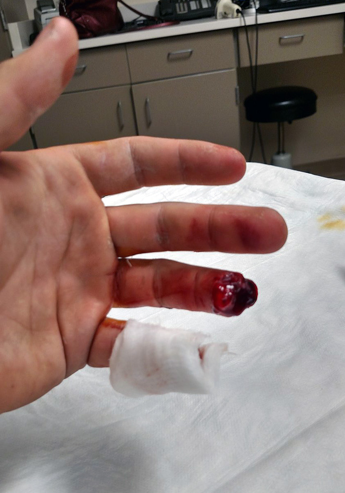“When I realized that my fingers were gone I felt this empty, despair feeling. I thought, <em>how much of my fingers are missing?</em> I’ve had some injuries before, but when you can see bone, it freaks you out.” Photo courtesy of Greg McKee. “When I realized that my fingers were gone I felt this empty, despair feeling. I thought, <em>how much of my fingers are missing?</em> I’ve had some injuries before, but when you can see bone, it freaks you out.” Photo courtesy of Greg McKee.